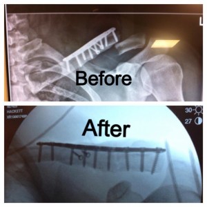 Snowboarder Nate Holland's X-rays from this week's surgery show the hardware from his previous clavicle fracture. (photo: Facebook)