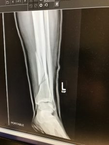 X-rays reveal the fractures sustained by pro snowboarder Jeremy Jones in a Jan. 11 accident in Utah. (photo: GoFundMe.com)